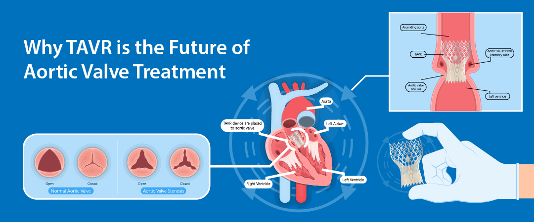 Aortic Valve Treatment