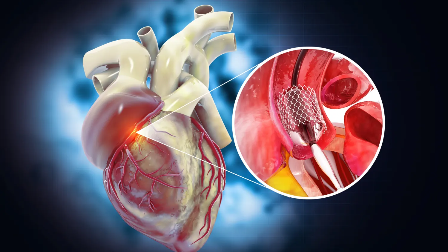Complex Coronary Interventions